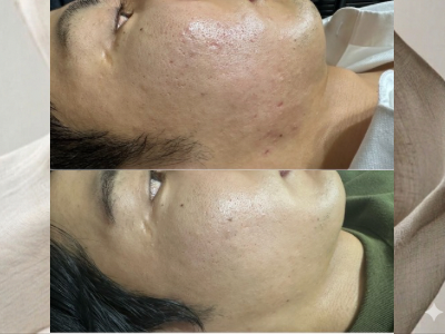 Before After 10